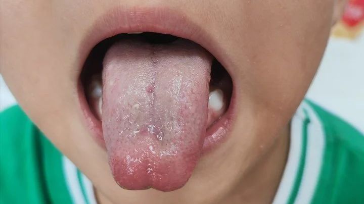 火龙罐改善小儿肺炎支原体感染